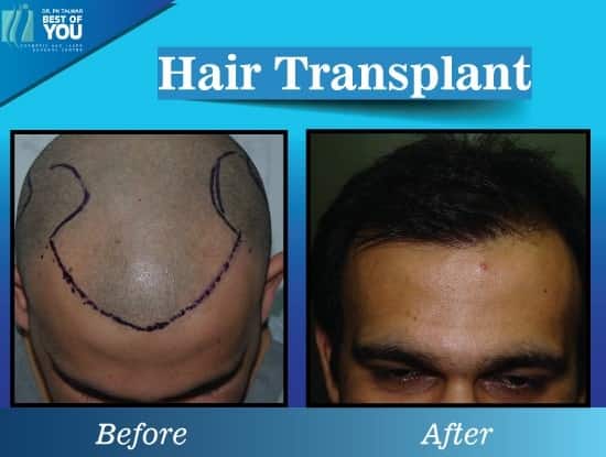 hair transplant result at Dr PK Talwar